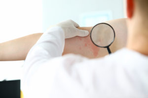 B Vitamins to Reduce Skin Cancer